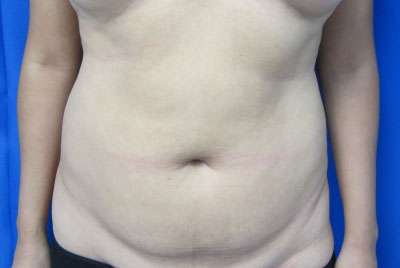 Tummy Tuck Before & After Patient #10690