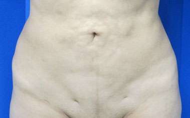 Tummy Tuck Before & After Patient #10693