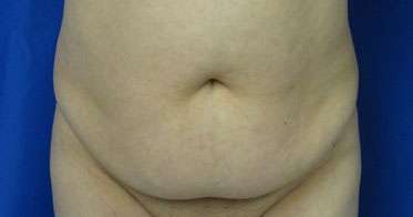 Tummy Tuck Before & After Patient #10696
