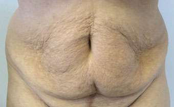Tummy Tuck Before & After Patient #10699