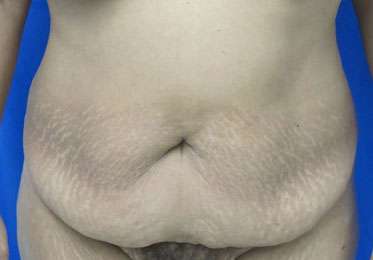 Tummy Tuck Before & After Patient #10705