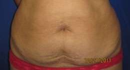 Tummy Tuck Before & After Patient #10708