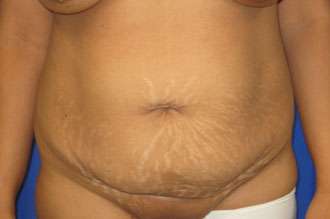 Tummy Tuck Before & After Patient #10711