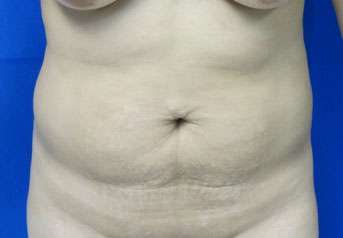 Tummy Tuck Before & After Patient #10714