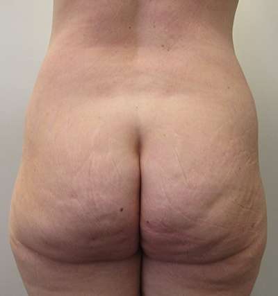 Brazilian Butt Lift Before & After Patient #6403