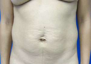 Tummy Tuck Before & After Patient #10717