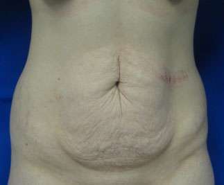 Tummy Tuck Before & After Patient #10720