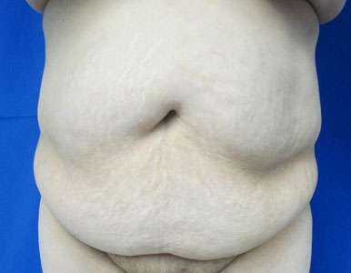 Tummy Tuck Before & After Patient #10726