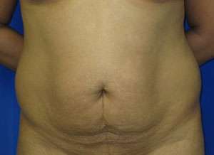 Tummy Tuck Before & After Patient #10729