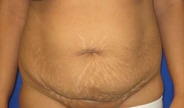 Tummy Tuck Before & After Patient #10732