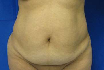 Tummy Tuck Before & After Patient #10737