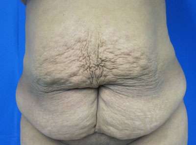Tummy Tuck Before & After Patient #10740