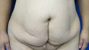 Tummy Tuck Before & After Patient #10743