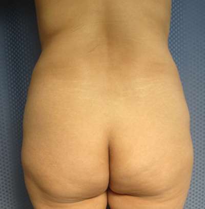 Brazilian Butt Lift Before & After Patient #6408