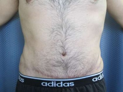 Tummy Tuck Before & After Patient #10749