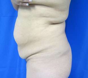 Tummy Tuck Before & After Patient #10752