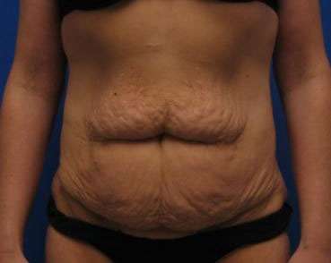 Tummy Tuck Before & After Patient #10755