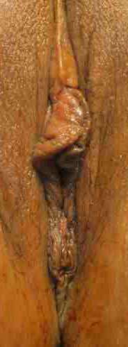 Vaginal Rejuvenation Before & After Patient #10758