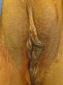 Vaginal Rejuvenation Before & After Patient #10761