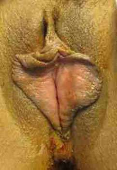 Vaginal Rejuvenation Before & After Patient #10764
