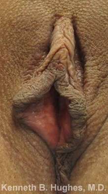 Vaginal Rejuvenation Before & After Patient #10770