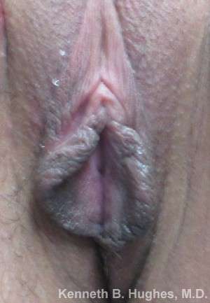 Vaginal Rejuvenation Before & After Patient #10773