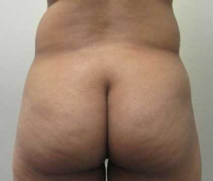 Brazilian Butt Lift Before & After Patient #6411