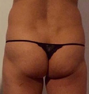 Brazilian Butt Lift Before & After Patient #7024