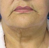 Brow Lift Before & After Patient #8129
