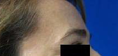 Brow Lift Before & After Patient #8119