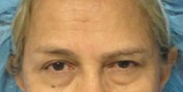 Brow Lift Before & After Patient #8116