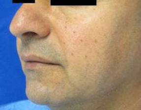 Chin Implant Before & After Patient #8312