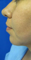 Chin Implant Before & After Patient #8302