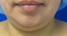 Chin Liposuction Before & After Patient #8332
