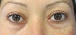 Eyelid Surgery Before & After Patient #8472