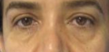 Eyelid Surgery Before & After Patient #8454