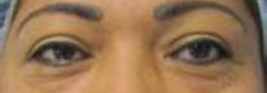 Eyelid Surgery Before & After Patient #8442