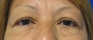 Eyelid Surgery Before & After Patient #8436
