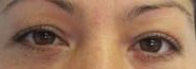 Eyelid Surgery Before & After Patient #8430