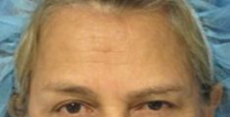 Eyelid Surgery Before & After Patient #8421