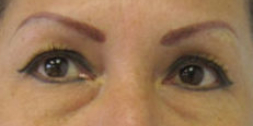 Eyelid Surgery Before & After Patient #8412