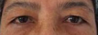 Eyelid Surgery Before & After Patient #8406