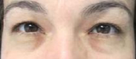 Eyelid Surgery Before & After Patient #8403