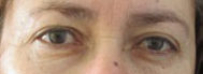 Eyelid Surgery Before & After Patient #8400