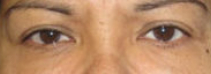Eyelid Surgery Before & After Patient #8397