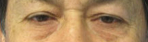 Eyelid Surgery Before & After Patient #8394