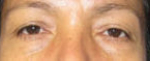 Eyelid Surgery Before & After Patient #8391