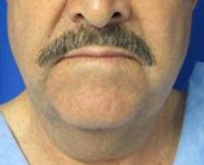 Neck Lift Before & After Patient #10039