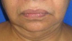 Facelift Before & After Patient #8495