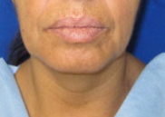 Facelift Before & After Patient #8487